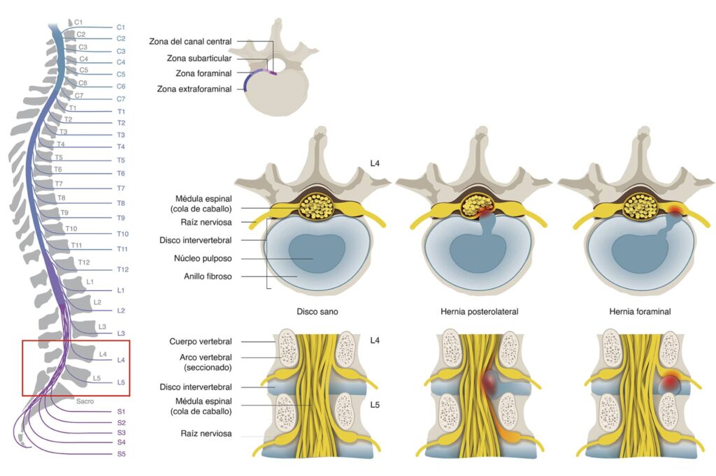 Patologías de la columna vertebral Esquema médico que muestra la columna vertebral, sección de la médula espinal y comparativa entre disco sano, hernia posterolateral y hernia foraminal.